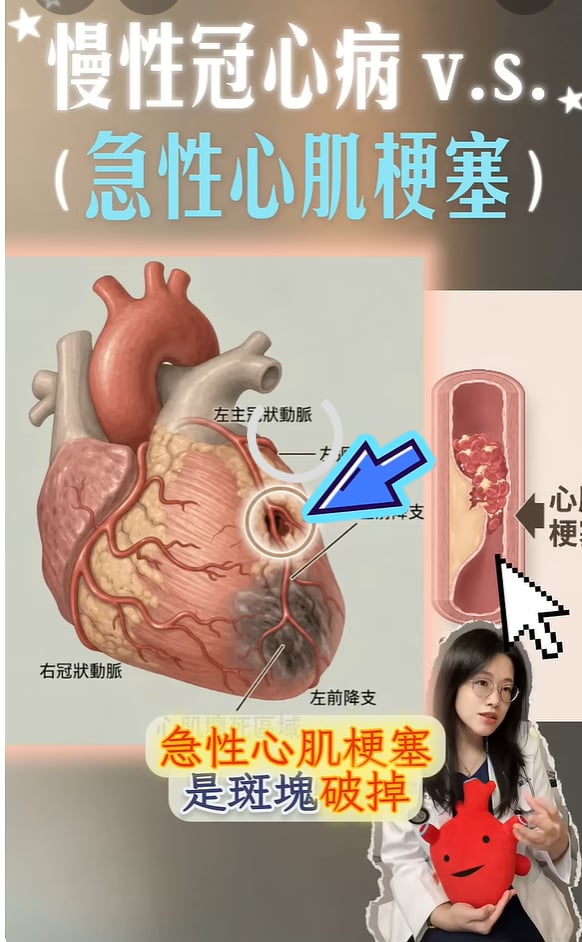 年輕又運動，為什麼會心肌梗塞？認識冠狀動脈心臟病
